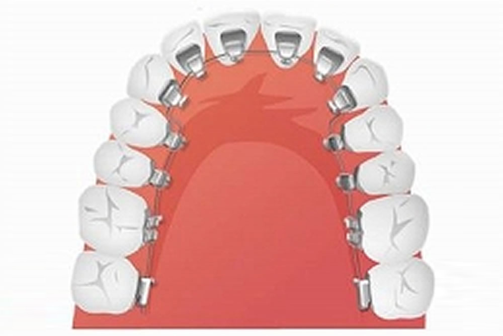 リンガル(舌側)矯正